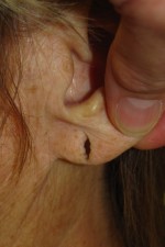 Earlobe Repair