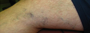 Sclerotherapy