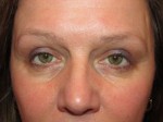 Eyelid and Upper Facial Surgery