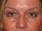 Eyelid and Upper Facial Surgery