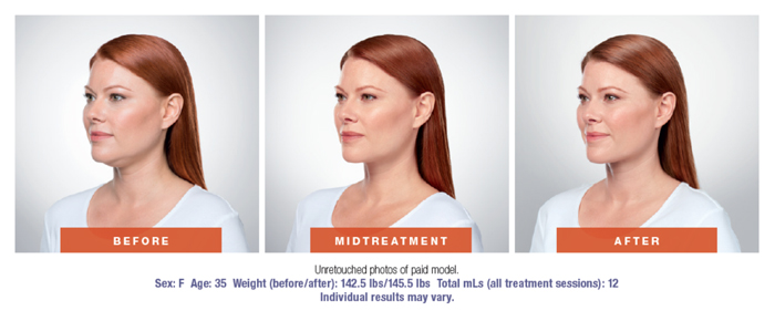 Kybella Before & After Results