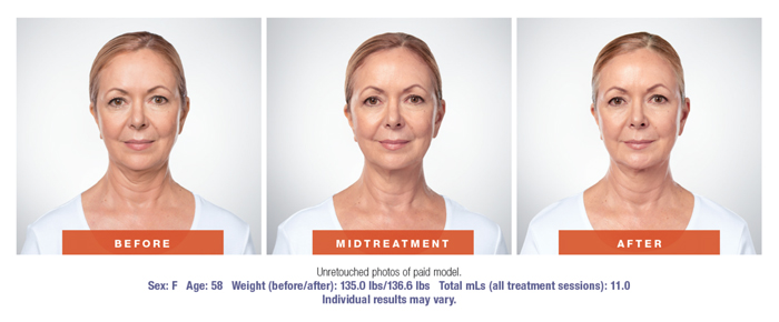 Kybella Before & After Results