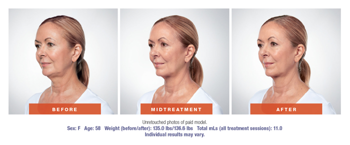 Kybella Before & After Results