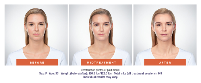 Kybella Before & After Results