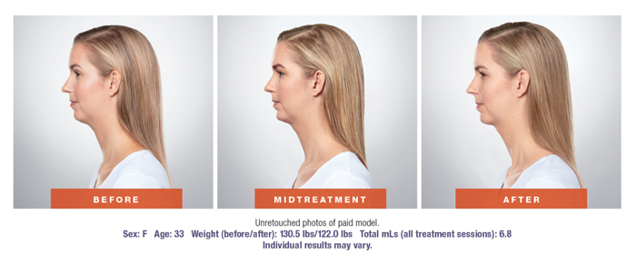 Kybella Before & After Results