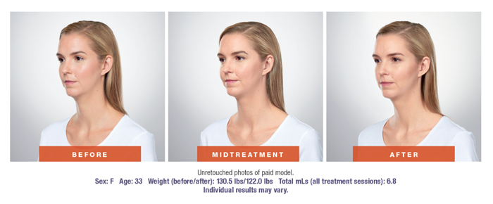 Kybella Before & After Results