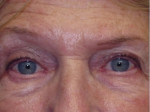 Eyeliner Micropigmentation