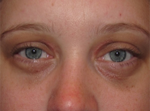Removal of Skin Growths
