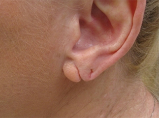 Earlobe Repair