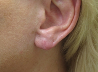 Earlobe Repair