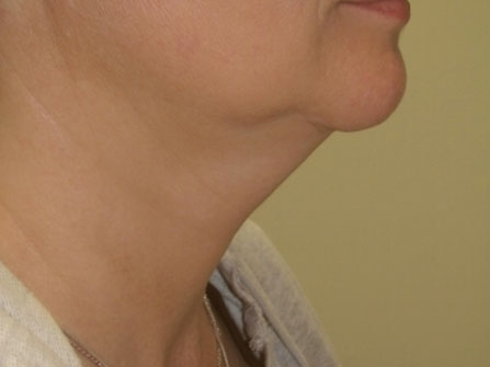 Kybella