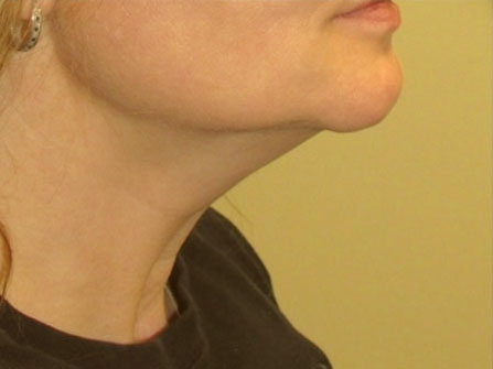 Kybella