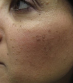 Removal of Skin Growths