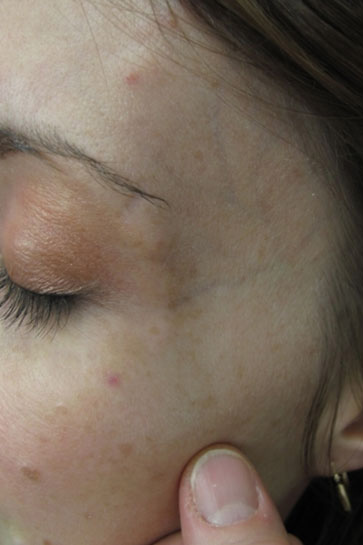 Laser to Remove Brown Spots