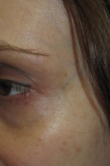 Laser to Remove Brown Spots