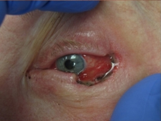 Skin Cancer Reconstruction