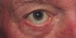 Skin Cancer Reconstruction