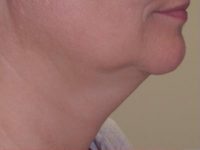 Kybella