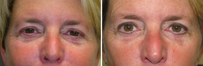 Eyeliner Micropigmentation before and after photos in Rhode Island
