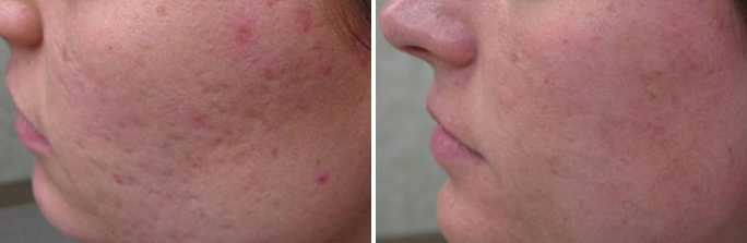 Scar removal before and afters in Rhode Island by Dr. Enzer