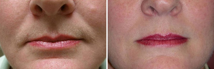 Facial fat transfer before and afters in Rhode Island by Dr. Enzer