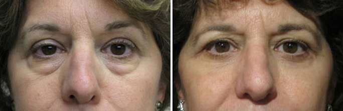 Mid Facelift before and afters by Dr. Enzer in Rhode Island