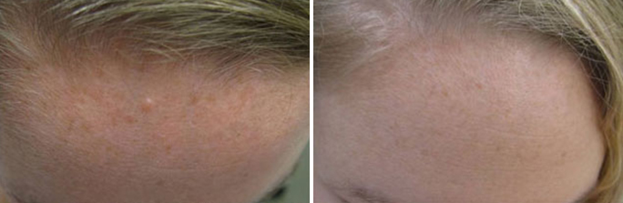 Mole Removal before and after photos in Rhode Island