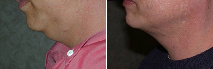 Neck liposuction before and after photos in Rhode Island