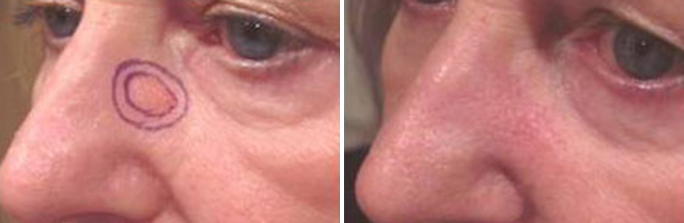 Skin Cancer Treatment before and after photos in Rhode Island