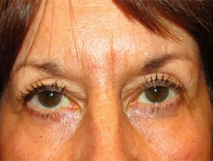 Eyelid and Upper Facial Surgery