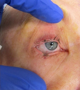 Skin Cancer Reconstruction