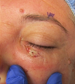 Skin Cancer Reconstruction