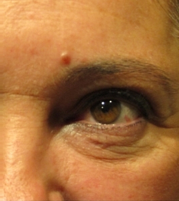 Skin Cancer Reconstruction