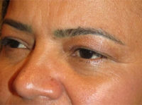 Eyelid and Upper Facial Surgery