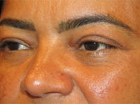 Eyelid and Upper Facial Surgery