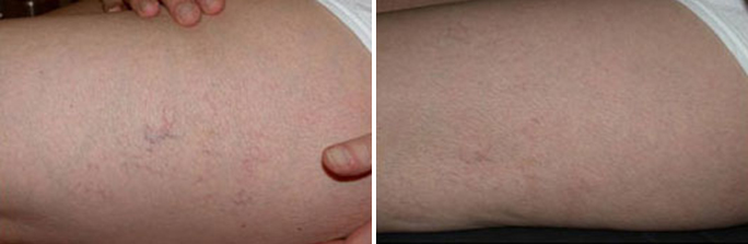 Spider Vein Treatment before and after photos in Rhode Island