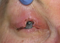 Skin Cancer Reconstruction