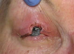 Skin Cancer Reconstruction