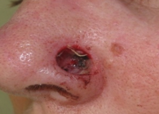 Skin Cancer Reconstruction