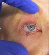 Skin Cancer Reconstruction