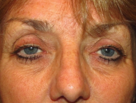 Eyelid and Upper Facial Surgery