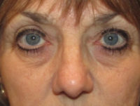 Eyelid and Upper Facial Surgery