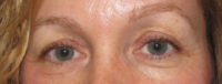 Eyelid and Upper Facial Surgery