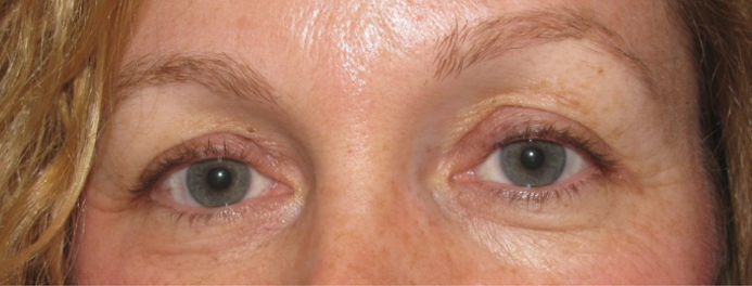 Eyelid and Upper Facial Surgery