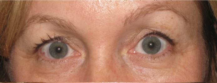 Eyelid and Upper Facial Surgery