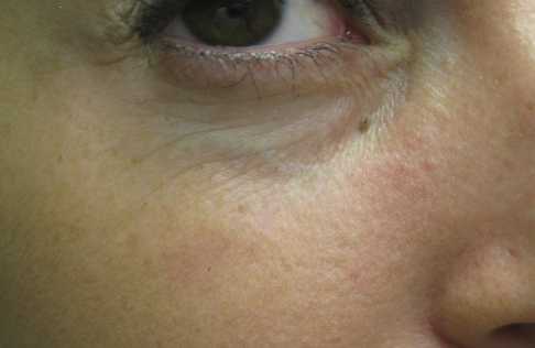 Eyelid and Upper Facial Surgery