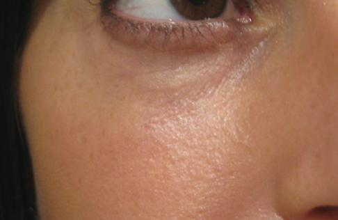 Eyelid and Upper Facial Surgery