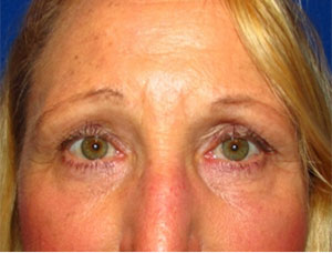 Eyelid and Upper Facial Surgery