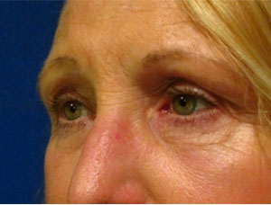 Eyelid and Upper Facial Surgery