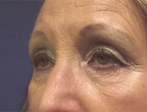 Eyelid and Upper Facial Surgery